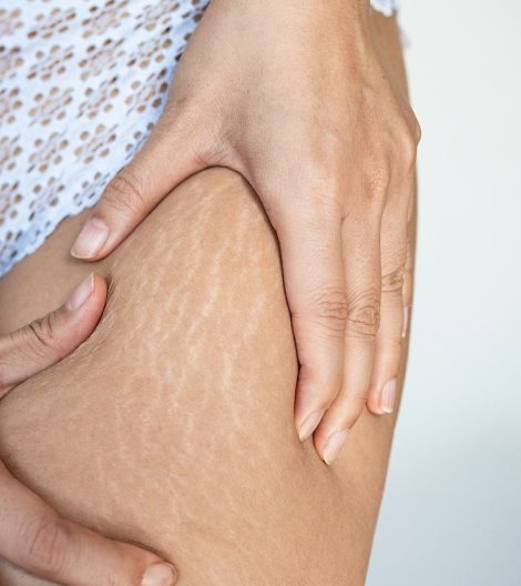 stretch-marks-on-female-legs-a-woman-s-hand-holds-2023-11-27-05-06-06-utc-min